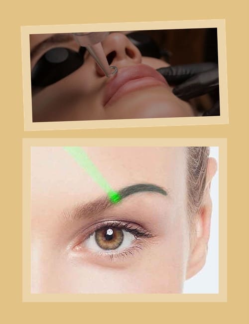 лазерне видалення татуаж