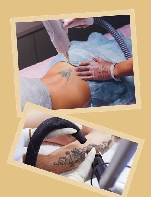 виводити тату лазером