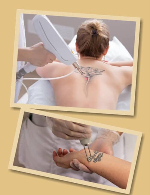 прибрати татуювання без ускладнень