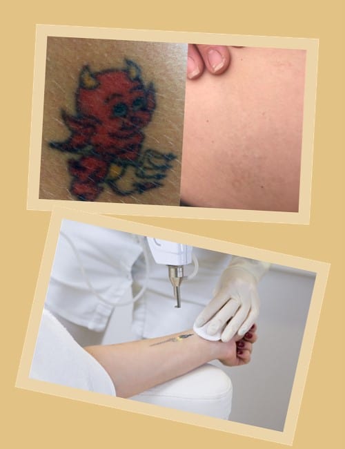 Вивести татуювання лазером