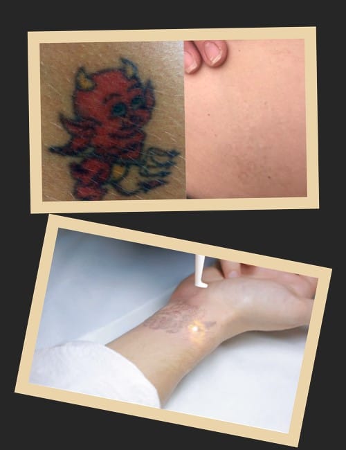 Види лазерів для виведення тату