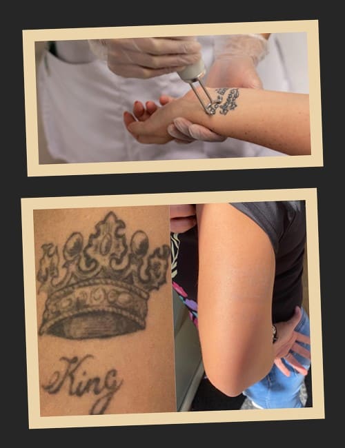 Як повністю вивести тату