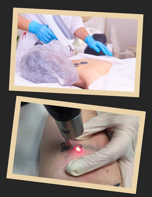 Принцип дії лазера при видаленні тату