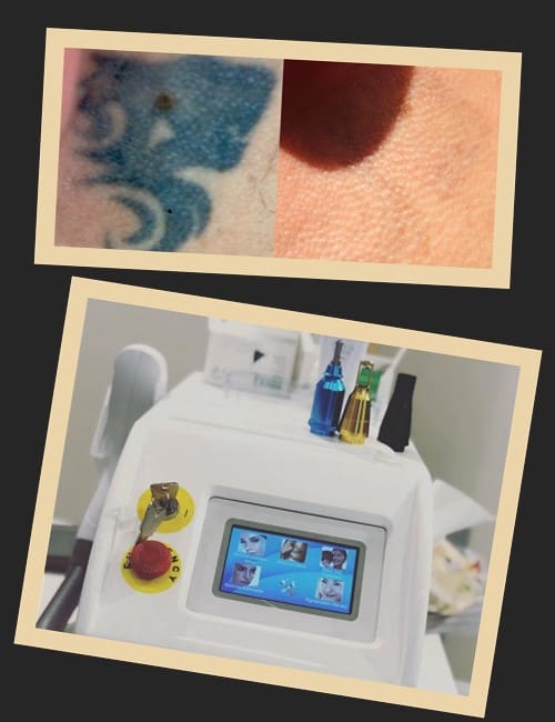 Лазер – сучасний ефективний спосіб звести натільний малюнок