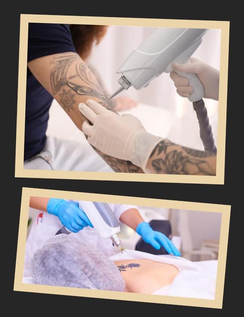 Фактори, що впливають на результат зведення татуювання