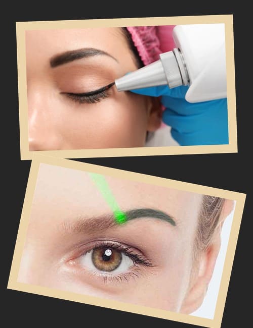 Принцип лазерного виведення татуажу