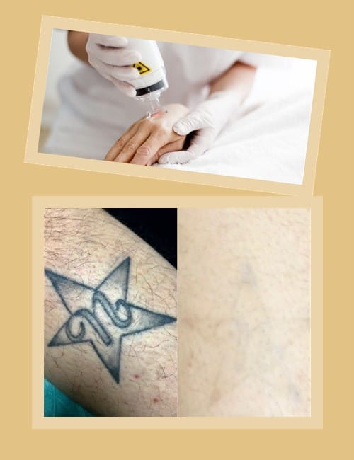 Лазерне видалення татуювань