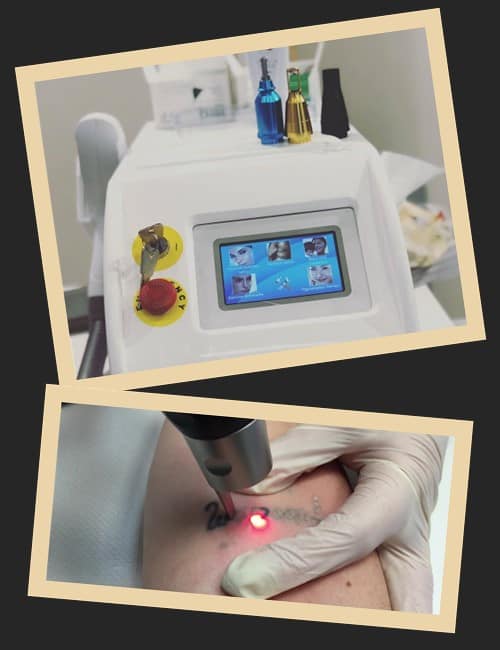 виводити татуювання лазером