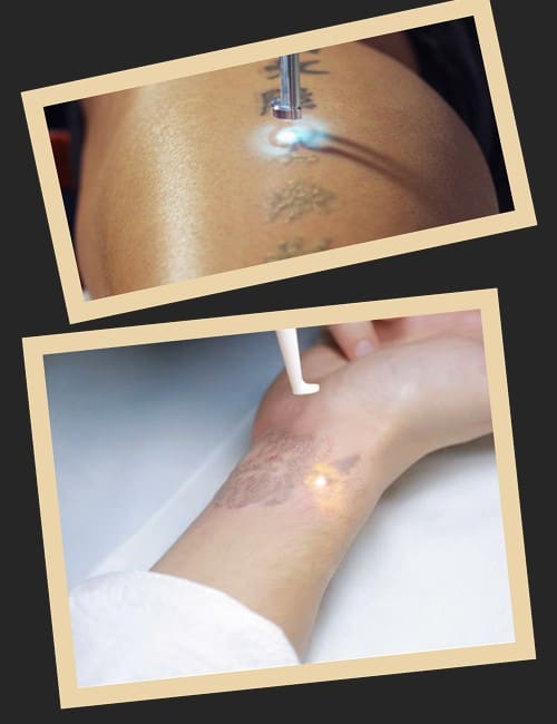 зведнення татуювання лазером