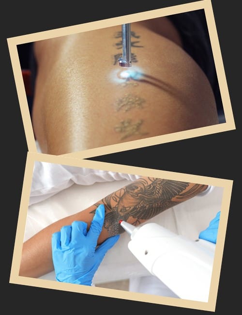 Лазерне видалення татуювань