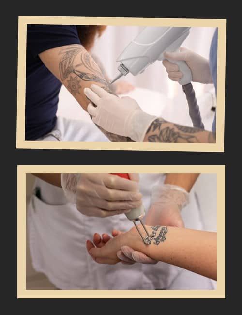 перед видаленням татуювання лазером