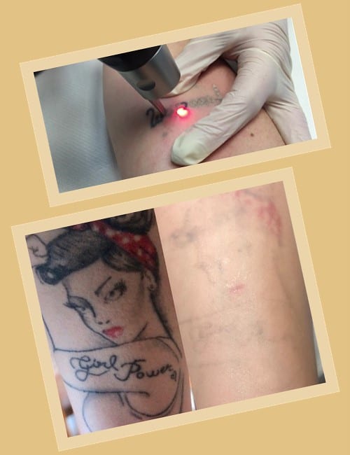 видалення тату