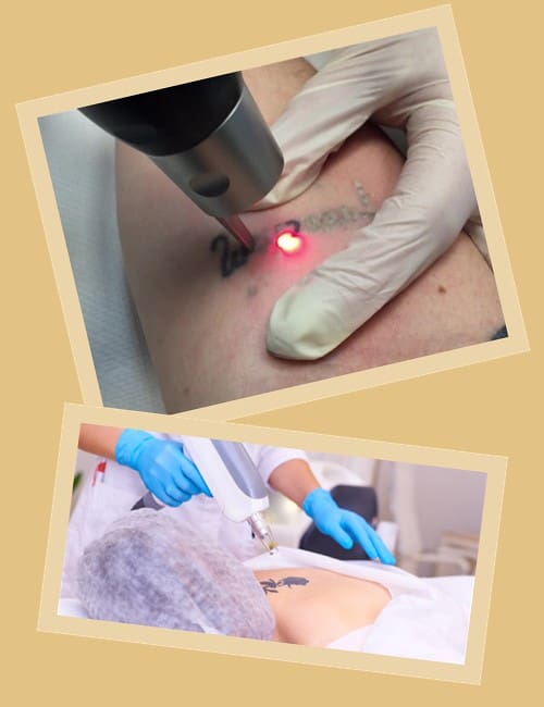 Лазерне видалення татуювань