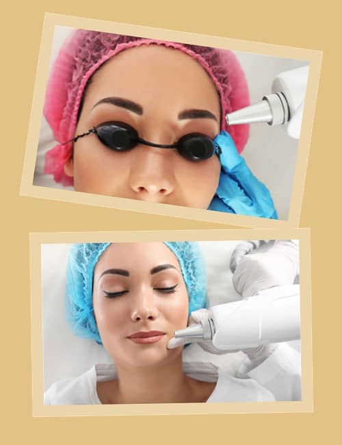 удаление татуаж на лице