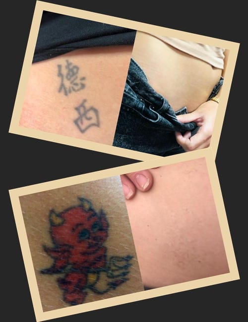 Скільки процедур потрібно, щоб видалити тату