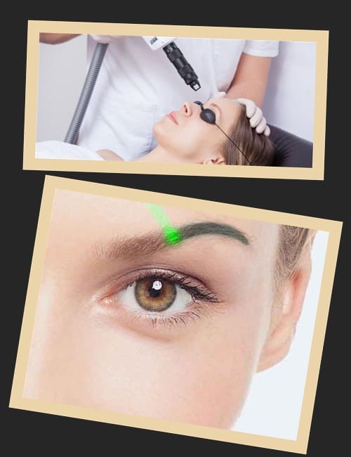 лазерний метод виведення татуажу