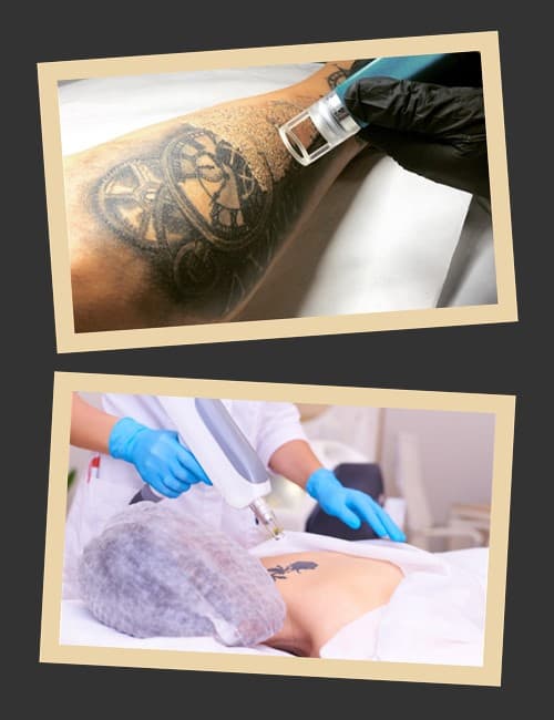 ефективність лазерного видалення тату