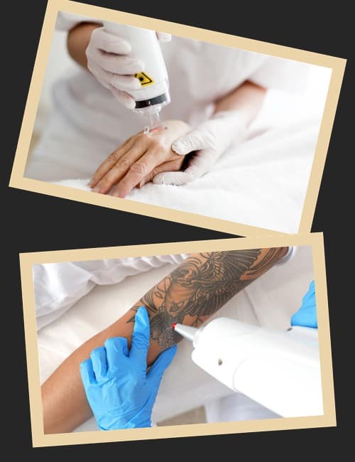 Технологія видалення тату лазером