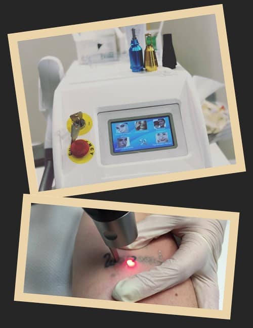 Видалення татуювань лазером має протипоказання