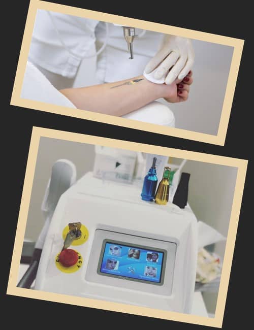 удаления нательного рисунка лазером