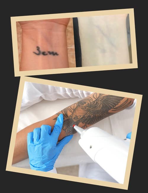 прибрати тату лазером