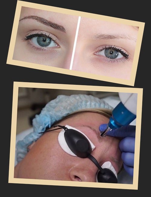 Як проходить процедура лазерного виведення татуажу