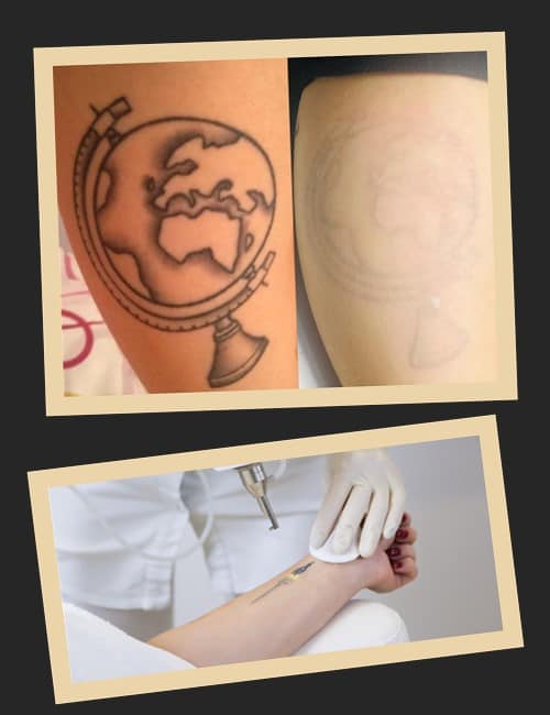 Як відбувається видалення тату лазером