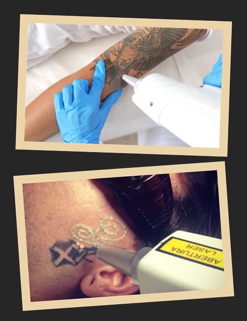 Лазерне виведення татуювань – сучасний спосіб