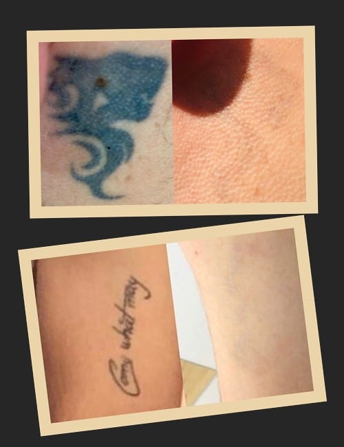 Чи можливо повністю видалити татуювання