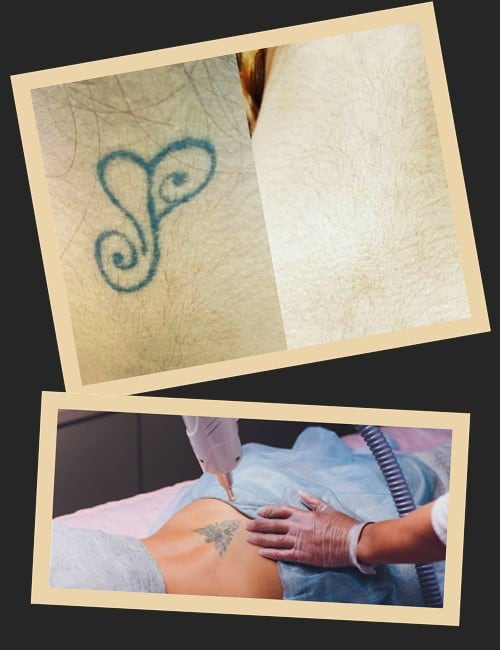 Ефективність видалення тату за допомогою лазера