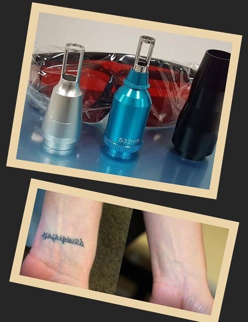 видалення татуювань лазером