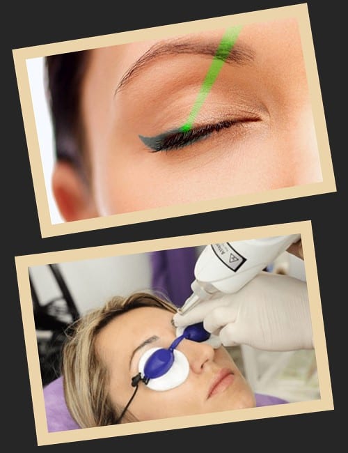 Якісне видалення татуажу