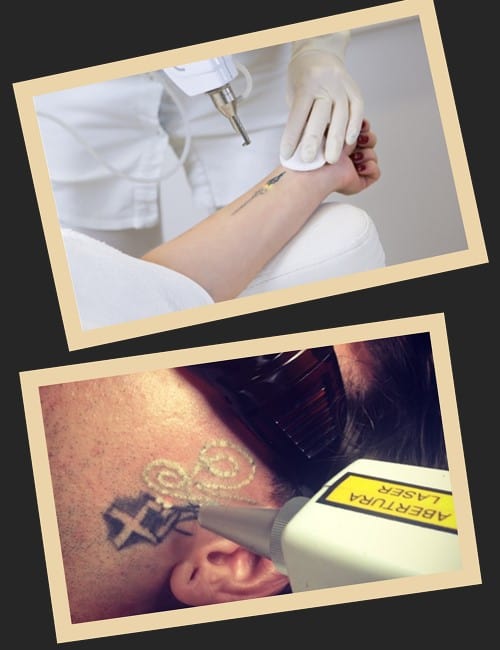 для повного виведення тату лазерним апаратом