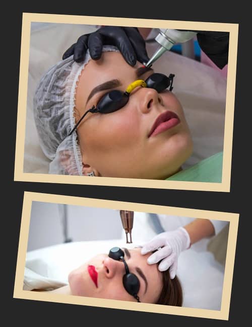 Видалення брів лазером