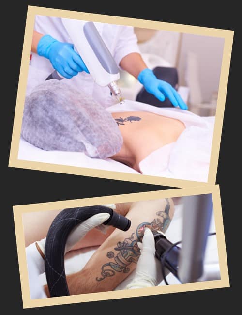 видалення тату