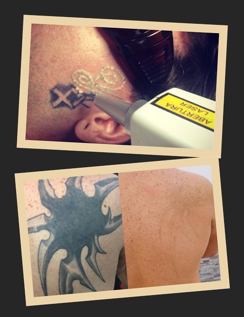 Як доглядати за шкірою після лазерного видалення тату