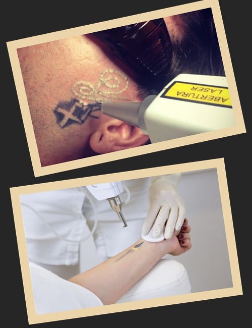 Ефективність лазерної процедури