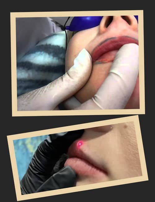 Методи видалення татуажу губ