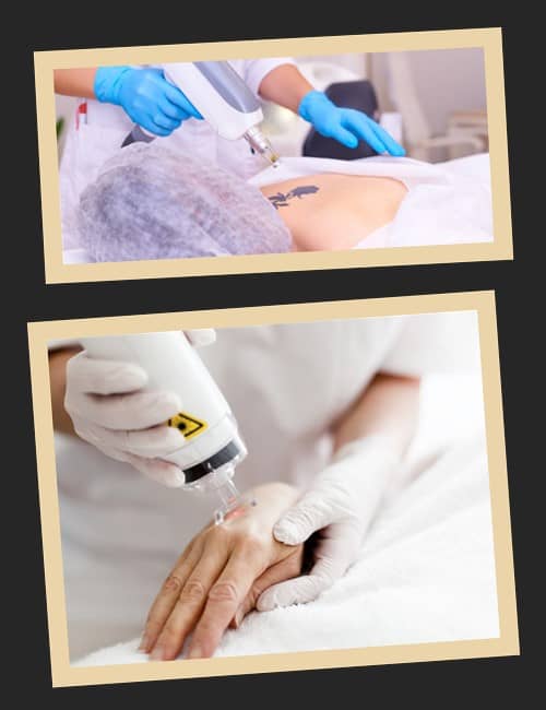 Як можна звести татуювання