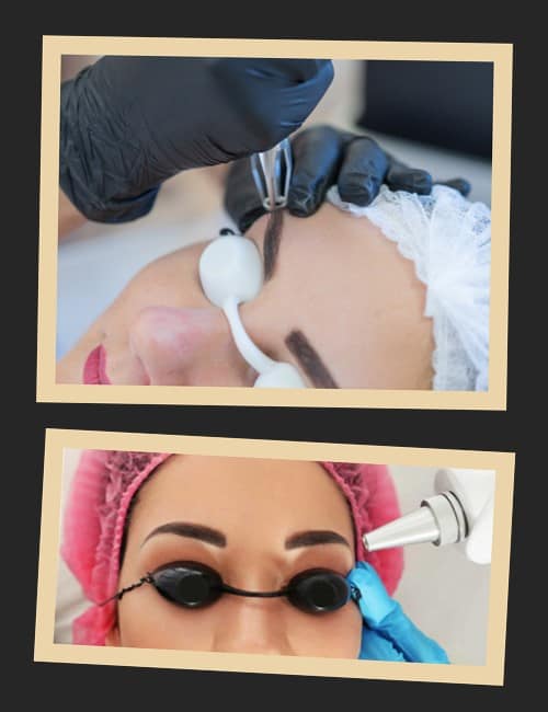 Видалити татуаж брів у Києві