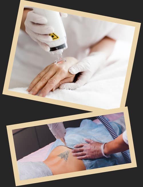 Вивести татуювання в Києві