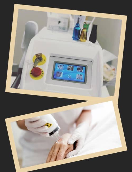 Все про лазер для удаления татуировок