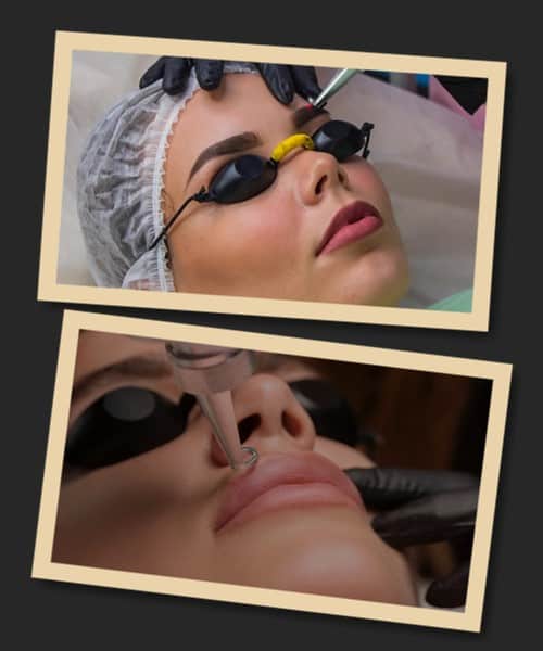 Звести татуаж лазером