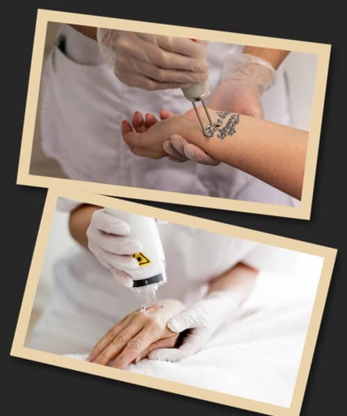 Все про виведення татуювання лазером