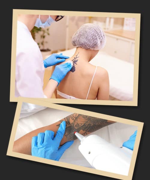 Як зводять татуювання?