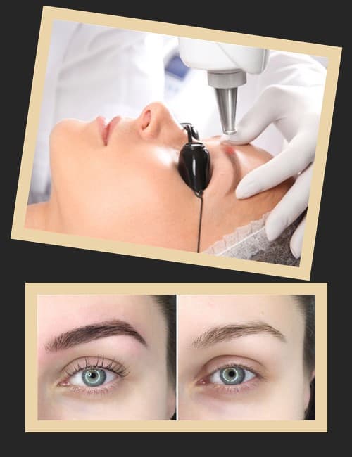 Видалення татуажу очей лазером