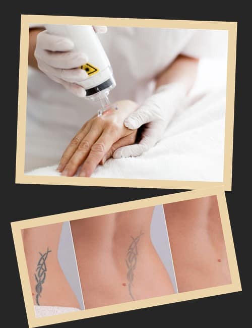 Як видалити тату без шраму