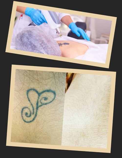 Процедура лазерного виведення тату