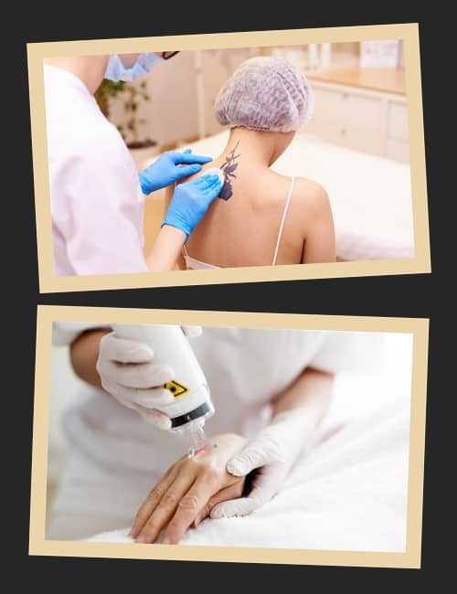 Лазерне виведення татуювань