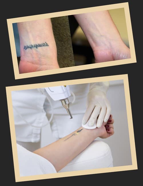 Основні методи видалення татуювань